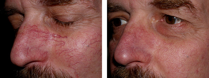 Facial Veins Laser 14