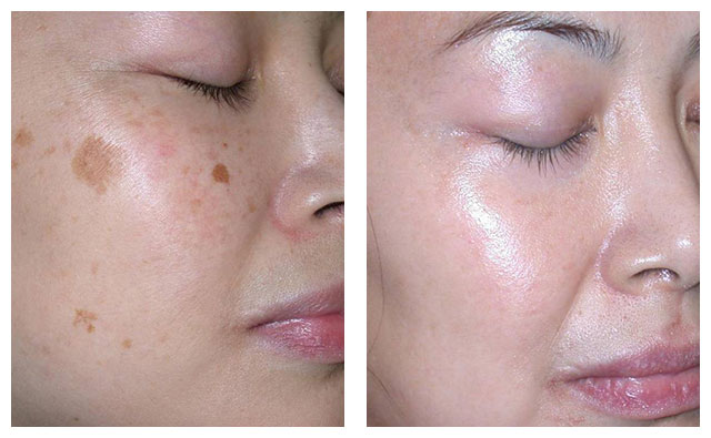 Skin Pigmentation, Age Spots and Sun Damage - DermaCare