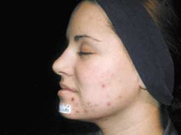Acne Scarring - Before