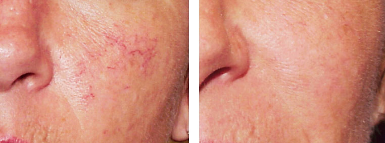 Spider Veins on Cheek. Before and After Laser Vein Removal Treatment