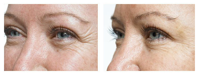 before and after fillers under eyes