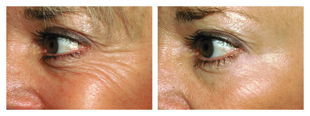Before and After Anti-Wrinkle Injections