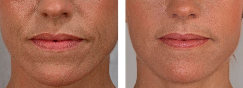 Dermal Fillers near me - Before and After