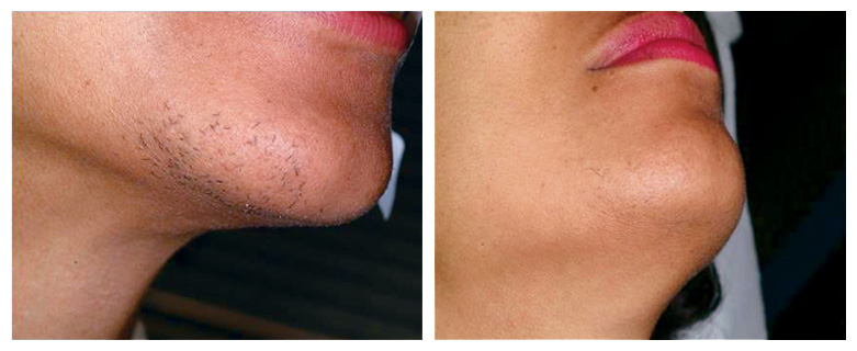 laserhairremoval_chin1_beforeafter