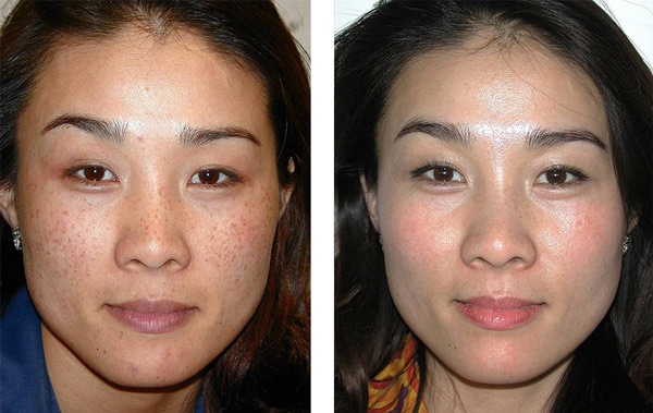 Skin Pigmentation Treatment